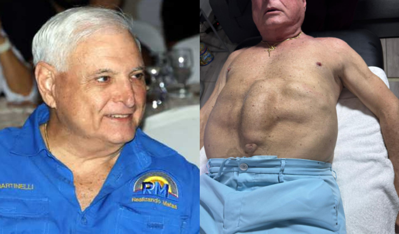 Expresidente Martinelli muestra su abdomen, tiene que operarse dos veces  