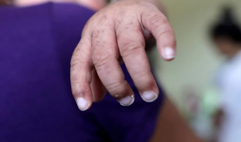 Panamá refuerza la vigilancia epidemiológica ante casos de sarampión en Costa Rica 