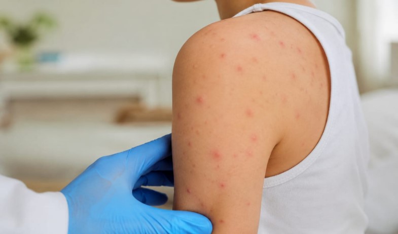 Activan vigilancia epidemiológica tras caso importado de sarampión en Panamá 