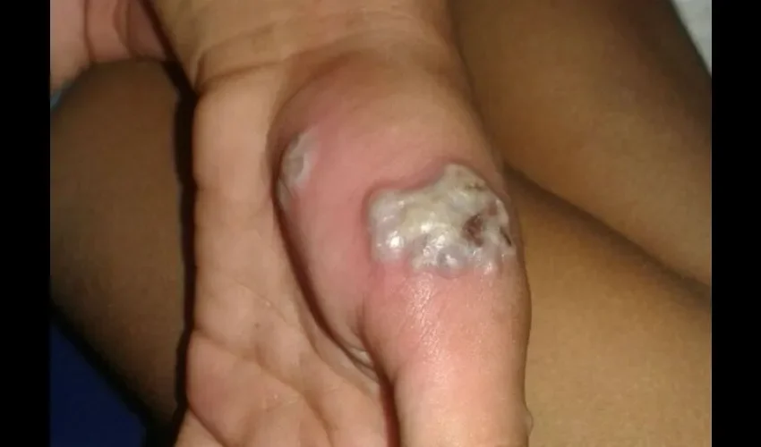 Infección por excremento de palomas 