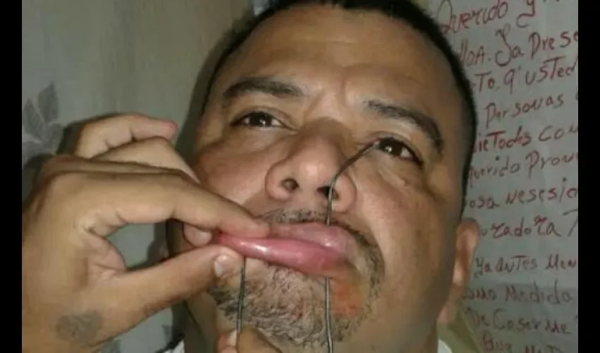 Edgardo Contreras  se cose la boca 