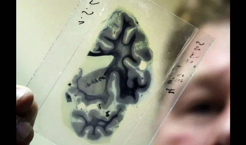 Zonas específicas del cerebro que provocan ataques epilépticos