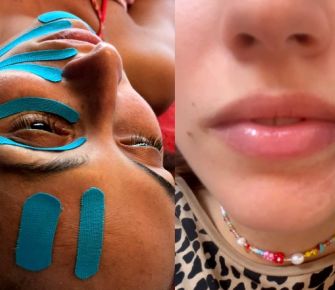 Parálisis facial: mitos y realidades  