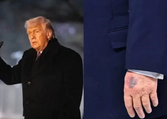  ¡Un moratón y muchas preguntas! Trump responde sobre su estado de salud 